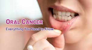 Image result for dental cancer
