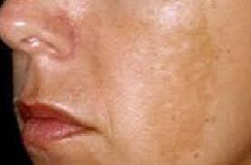 Image result for Diffuse Hyperpigmentation