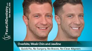 Maybe you would like to learn more about one of these? Receding Weak Chin And Small Jawline Quick Fix No Surgery