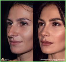 Nasenkorrektur Tipp Geschlossene Nasenkorrektur Vor Und Nach Der Nasenkorrektur 1 Jahr Na In 2020 Nose Surgery Rhinoplasty Nose Plastic Surgery Rhinoplasty Nose Jobs