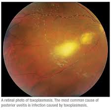 Uveitis that affects the back of your eye (posterior uveitis or panuveitis, including retinitis or choroiditis) tends to heal more slowly than uveitis in the front of the eye (anterior uveitis or iritis). Tailor Uveitis Treatment To Type And Severity