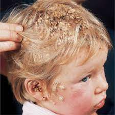 This is a chronic health condition. Fungal Infections Of The Skin Hair And Nails Fitzpatrick S Color Atlas And Synopsis Of Clinical Dermatology Seventh Edition