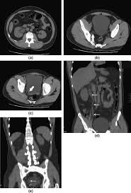 Image result for Helical CT Urogram