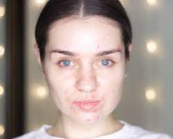 Maybe you would like to learn more about one of these? Vitamin E Oil For Acne Reddit