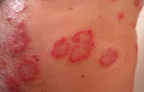 Image result for Skin Infection