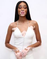 Black And White Skin Condition Model Lealeebarros Chantelle Brown Young Winnie Harlow Vitiligo Model