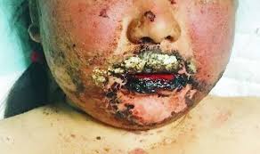 The purpose of the foundation is to provide the public and medical communities with information on adverse drug reactions. Stevens Johnson Syndrome In Systemic Lupus Erythematosus The Bmj