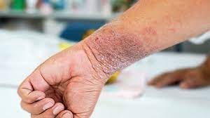 Necrotising fasciitis is relatively rare, although its prevalence is thought to be rising. All About Cellulitis Causes Symptoms Treatment And More Everyday Health