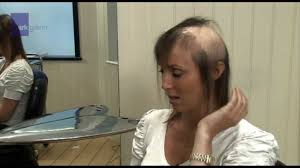 However, for about 60%, hair loss persists for 6 or more months after completion of radiotherapy, the authors note. Female Hair Loss Solution Mark Glenn Hair Enhancement London Youtube