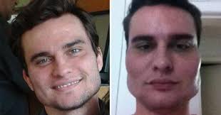 What's it like to go from being unattractive to gorgeous? 40 Patients Use Plastic Surgeon For Disfiguring Their Faces After Using Illegal Amounts Of Filler Link In Comments Botchedsurgeries