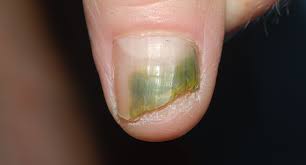 This is an infection along the lines of athlete's foot in that it can happen to anyone, no matter how particular they are it's caused by organisms that find their way underneath a nail. Nail Fungus Onychomycosis Laser Clinic Galway