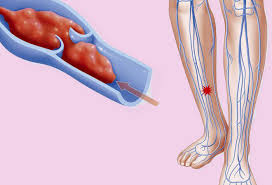 Vnimanie Pervye Simptomy Tromba V Noge Zdorove Seldon Novosti
