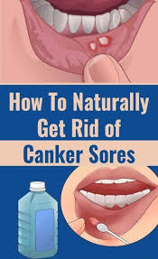 Home Remedies For Canker Sore On Tongue In 2020 Sore In Mouth Remedies Canker Sore Canker Sore Remedy