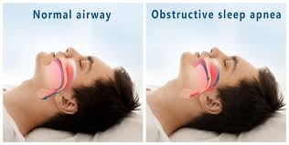 Image result for Sleep Apnea