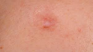 Basal cell (plural basal cells). Basal Cell Carcinoma Sclerodermiformes Altmeyers Encyclopedia Department Dermatology