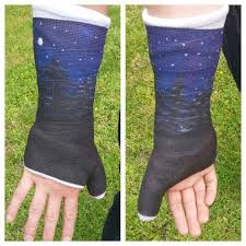 Arm Cast Painted With Trees And A Night Sky Arm Cast Cast Art Mom Cast