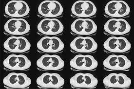 Moreover, a lung infection further compromises the ability of the lungs to function properly. Lung Cancer Scans Are Recommended For People 50 And Older With Shorter Smoking Histories The New York Times