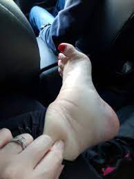 Ankles swelling is common in long distance flight. Super Swollen Legs After Long Haul Flight March 2018 Babycenter Australia