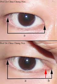Oct 31, 2017 · to talk about asian eyes is to have a unique lexicon. Epicanthal Fold Eye Shefalitayal