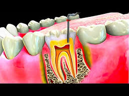 Check spelling or type a new query. Dead Tooth Causes Treatment Options And Symptoms