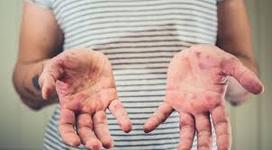 • coxsackievirus a16 is typically the most common cause of hand, foot Penyakit Penyakit Coxsackie Gejala Penyebab Pengobatan Klikdokter Com
