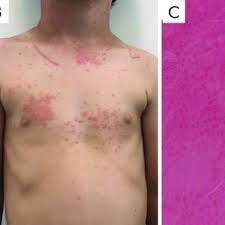A psoríase é uma doença inflamatória da pele, autoimune, não contagiosa e sem cura. Psoriase Gutata Crianca De 5 Anos Com Multiplas Papulas E Placas Download Scientific Diagram