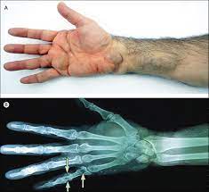 Multiple Enchondromas And Skin Angiomas Maffucci Syndrome The Lancet
