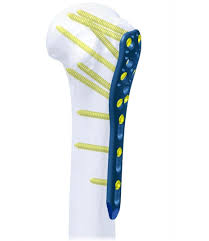 Buy Humerus, Radius, Ulna Implant - Madison Ortho
