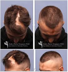 Cysts grow slowly and usually don't hurt, but sometimes they can get swollen and painful and may ooze a thick fluid with a bad smell. Hair Transplantation In Cicatricial Alopecia The Role Of Autologous Fat Transfer International Journal Of Regenerative Medicine Science Repository Open Access