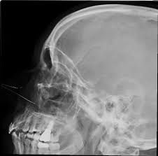 Image result for Sinus X Ray