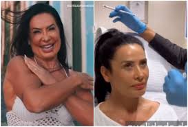 Scheila Carvalho remove ácido hialurônico do rosto: Meu olhar abriu