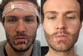 Read on to learn more about facial hair restoration. Beard Transplant Beard Transplant Cost Procedure Clinics Dhi International