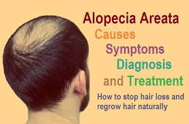 What are some types and causes of alopecia? Alopecia Areata Causes Symptoms And Treatment How To Stop Hair Loss Naturally The Scientific World Let S Have A Moment Of Science