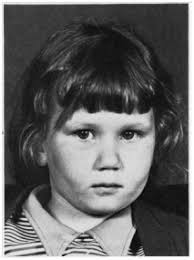 Duane Retraction Syndrome