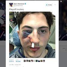It seems to only keep getting weirder. Blue Jackets Werenski Out For Playoffs With Face Fracture Wsyx