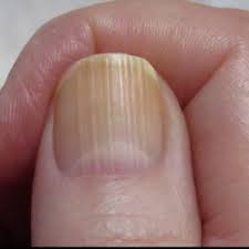 Check spelling or type a new query. What Do Nail Problems Mean For Your Health