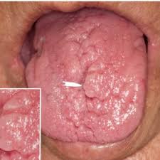 Transient lingual papillitis is a common painful inflammatory condition affecting one or several fungiform papillae on the tongue. Pdf Chronic Lingual Papulosis New Independent Entity Or Mature Form Of Transient Lingual Papillitis