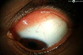 Image result for lesion sclera
