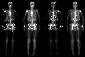 Before having a bone scan, a substance containing a when breast cancer is diagnosed, your doctors will give it a stage. Skeletal Metastases Physiopedia