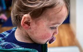 nhập viện do bệnh sởi: Tin tức, Video, hình ảnh nhập viện do bệnh sởi