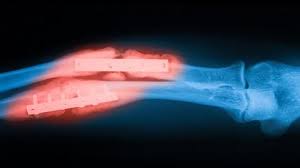 Image result for Fracture Complication