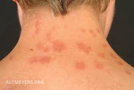 Eular recommendations for the management of systemic lupus erуthematosus. Lupus Erythematodes Kutaner Ubersicht Altmeyers Enzyklopadie Fachbereich Dermatologie