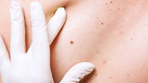 It's the only way to know whether you have skin cancer. App Uses Adapted Israeli Airforce Imaging Tech To Detect Skin Cancer Israel21c