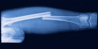 Kemik Kirilmasi Nasil Anlasilir