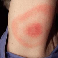 Plus de 50 % des patients ayant eu un erytheme migrant non traité feront de l'arthrite (genoux++), environ 10 % auront une maladie neurologique. Erytheme Migrant Lyme Photo