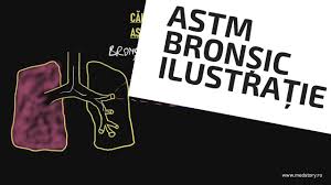 Nu poţi să mai interacţionezi. Tratament In Criza De Astm Bronsic Ilustratie Youtube