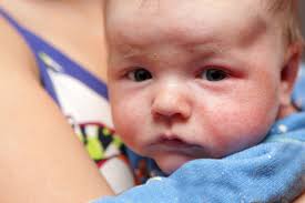 Veelvoorkomende Huidaandoeningen Bij Je Baby