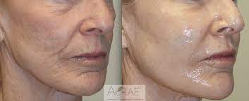 You will see improvements within a few days of your first treatment with morpheus8. Morpheus8 What Is Morpheus8 Dr Emami Aurae Md Accutite