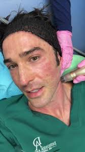 Radiofrequency Microneedling