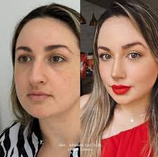 A mesma pessoa, mas outro nariz 👃🏼😮‍💨 Isso é Rinomodelação Estruturada!  ✨ Arrasta pro lado O que acharam do resultado? 🤍 ❗️Lembrando que: cada  nariz tem o formato mais lindo que ele